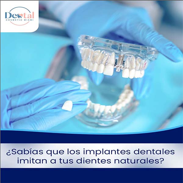 Implantes Dentales - Dental Cosmetic Miami
