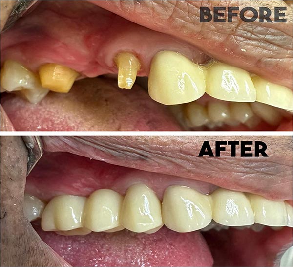 Before-After-Dental Cosmetic Miami