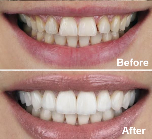Before and After Dental Cosmetic Miami