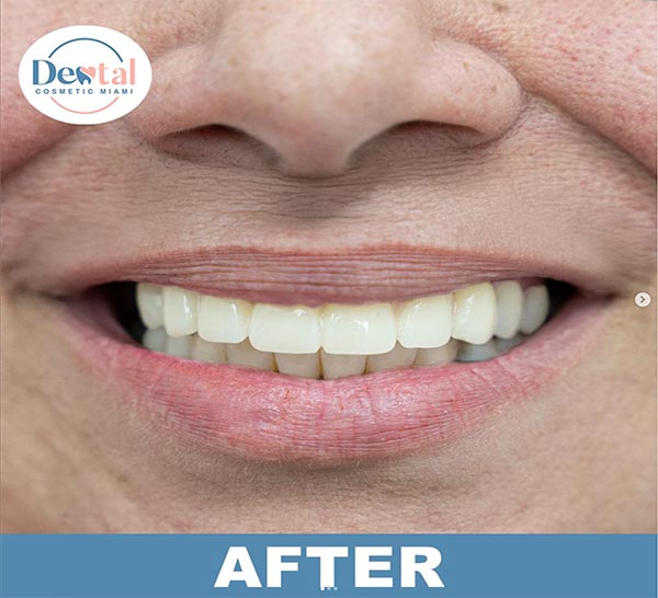 Transformation-Dental Cosmetic Miami