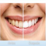 Tooth Whitening - Dental Cosmetic Miami